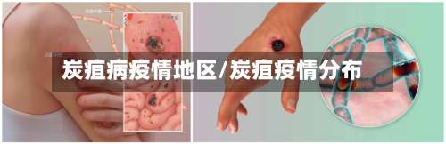 炭疽病疫情地区/炭疽疫情分布-第2张图片